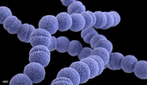 DOH: Streptococcal toxic shock syndrome not yet a health .